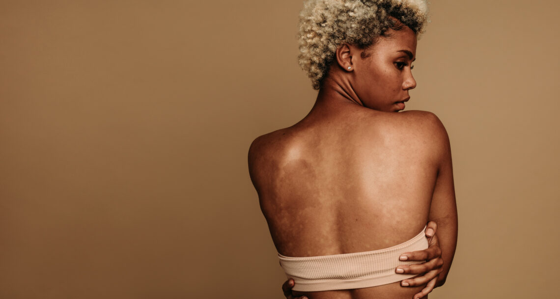 Hyperpigmentation 101: How to Fade Dark Spots Without Damaging Your Skin