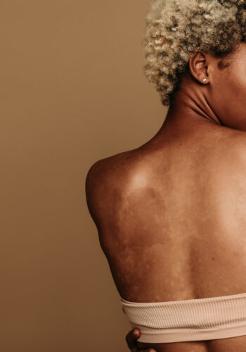 Hyperpigmentation 101: How to Fade Dark Spots Without Damaging Your Skin